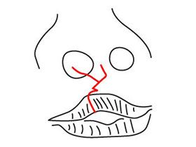 Cirugía del labio y reposicionamiento de la nariz | Fisuras Labiopalatinas
