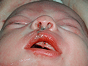 Corrección del labio y reposición de la nariz | Fisuras Labiopalatinas